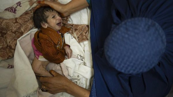 Gizi Buruk Bayangi Jutaan Anak-anak di Afghanistan