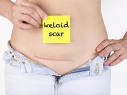 Muncul Keloid Usai Operasi Caesar? Ini 4 Cara Menyamarkannya