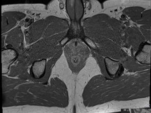Penis Patah Saat Berhubungan Intim, Pria Ini Catat Sejarah di Dunia Medis