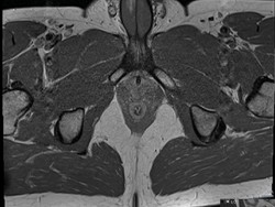 Penis Patah Saat Berhubungan Intim, Pria Ini Catat Sejarah di Dunia Medis