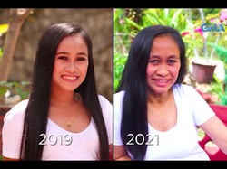 Idap Kondisi Langka, Gadis 16 Tahun Ini Terlihat Seperti Nenek