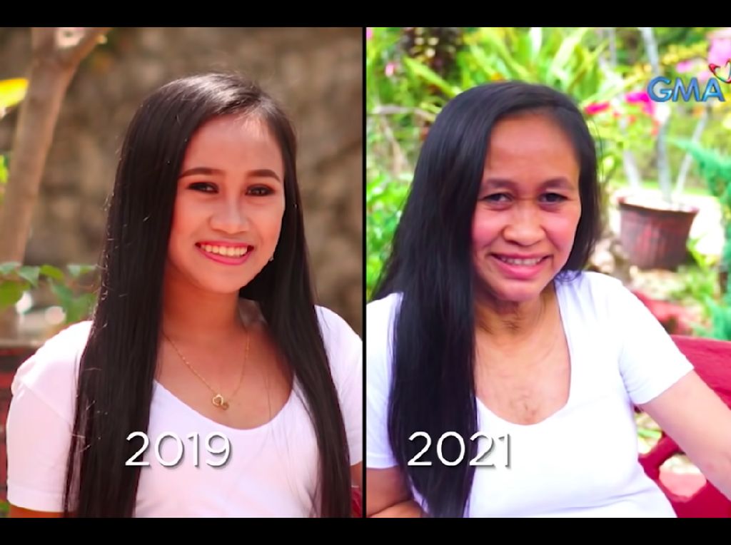 Idap Kondisi Langka, Gadis 16 Tahun Ini Terlihat Seperti Nenek Idap Kondisi Langka, Gadis 16 Tahun Ini Terlihat Seperti Nenek