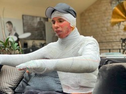 Desainer Balmain Buka Rahasia, Ungkap Luka Bakar di Wajah Akibat Rumah Meledak