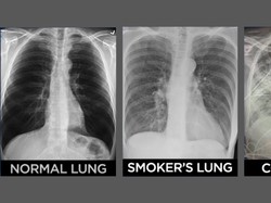Beda Penampakan Paru-paru Pasien COVID-19 Vs Perokok, Parahan Mana?