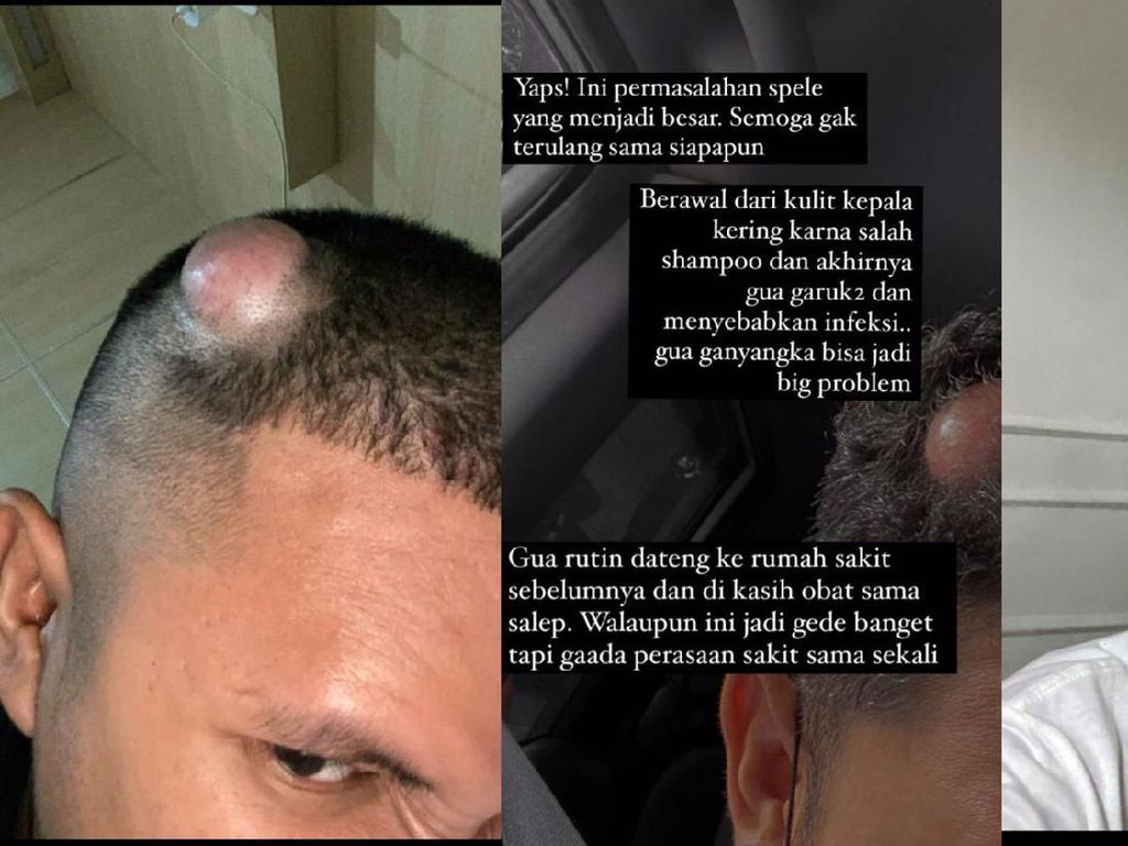 Viral Pria Kena Tumor di Kepala, Mengaku Gara-gara Salah Sampo?