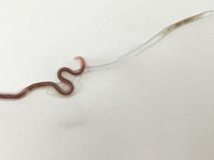 Gara-gara Makan Ikan Mentah, Ada Cacing Hidup di Amandel Wanita Ini