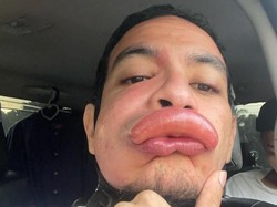 Aktor Ini Pamer Bibir Disengat Tawon, Fotonya Bikin Kasihan Sekaligus Ngakak