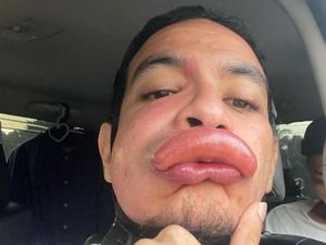 Aktor Ini Pamer Bibir Disengat Tawon, Fotonya Bikin Kasihan Sekaligus Ngakak Aktor Ini Pamer Bibir Disengat Tawon, Fotonya Bikin Kasihan Sekaligus Ngakak