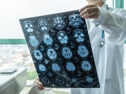 Bahaya Stroke Intai Siapa Saja, Gimana Cara Tanganinya Sejak Dini?