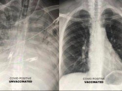 Penampakan Paru Pasien COVID-19 yang Sudah Vaksin Vs Belum, Ini Hasilnya