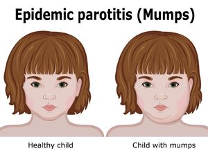 Pengertian Penyakit Parotitis: Penularan, Pencegahan hingga Apakah Bisa Sembuh? Pengertian Penyakit Parotitis: Penularan, Pencegahan hingga Apakah Bisa Sembuh?