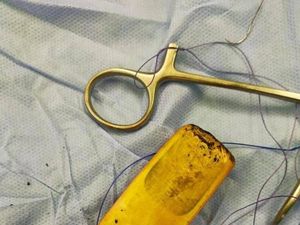 Gokil! Pria Ini Sengaja Telan Handphone dan Membiarkannya Selama 6 Bulan