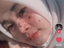 Viral Remaja Perawatan Facial Biar Bebas Jerawat, Endingnya Dirawat di RS