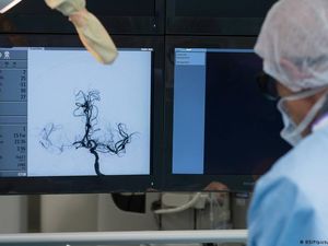 Waspada Stroke atau Serangan Otak Mendadak pada Usia Muda