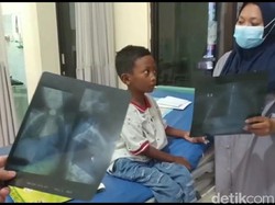 Koin yang Sebulan Nyangkut di Tenggorokan Bocah Brebes Akan Segera Diambil