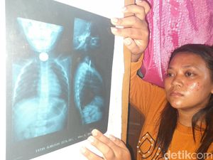 Tolong! Sudah Sebulan Lebih Uang Logam Nyangkut di Tenggorokan Bocah Ini
