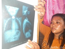 Tolong! Sudah Sebulan Lebih Uang Logam Nyangkut di Tenggorokan Bocah Ini