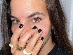 Kisah Model yang Wajahnya Rusak Diserang Anjing, Bibir dan Hidungnya Robek