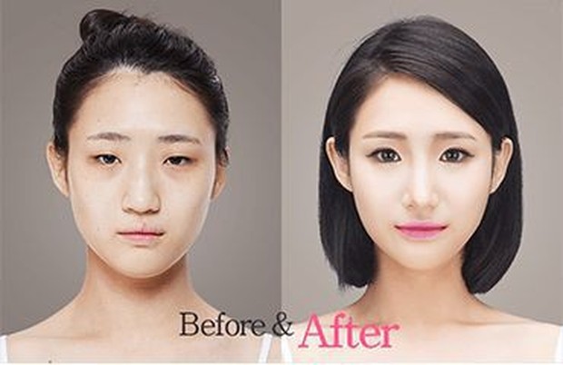 Before and After operasi plastik/Pinterest.com/William Sam