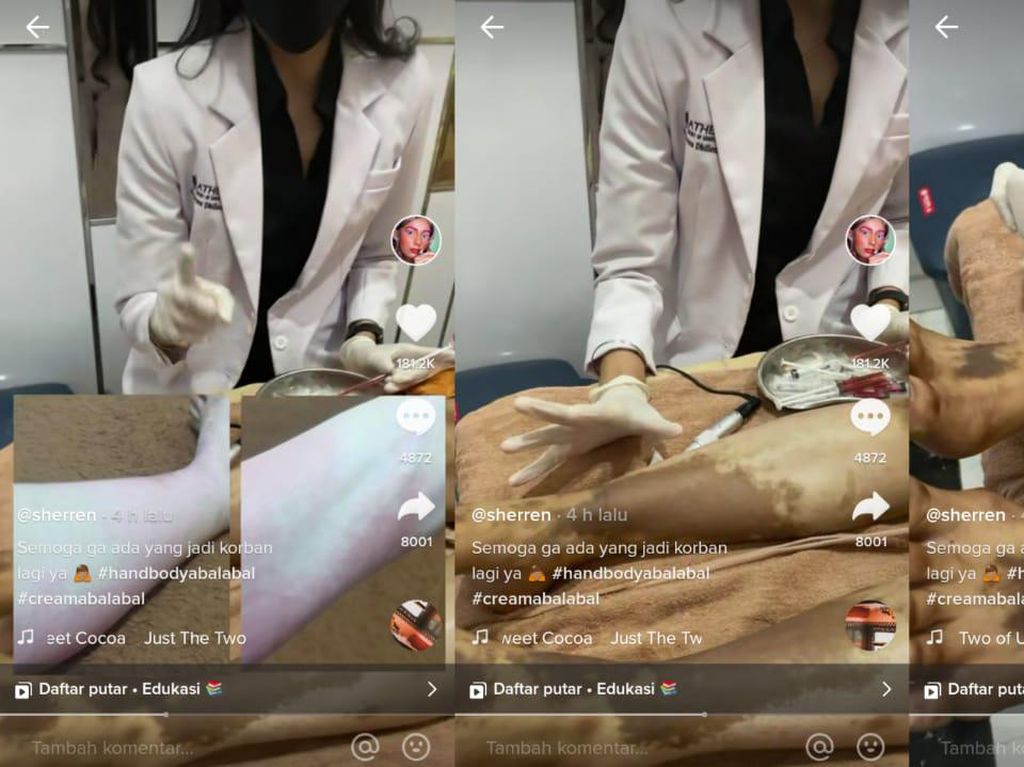 Viral Kulit Wanita Ini Gosong Gegara Hand Body Palsu, Ini Pesan Dokter Viral Kulit Wanita Ini Gosong Gegara Hand Body Palsu, Ini Pesan Dokter