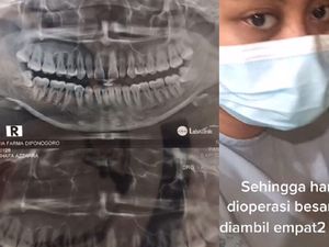 Cabut 4 Geragam Bungsu Sekaligus, Gimana Rasanya? Wanita Ini Mengalaminya