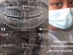 Cabut 4 Geragam Bungsu Sekaligus, Gimana Rasanya? Wanita Ini Mengalaminya