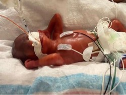 Masih Merah, Anak Ini Dapat Rekor Bayi Paling Prematur Sedunia