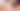 Ilustrasi kerokan (Shutterstock)