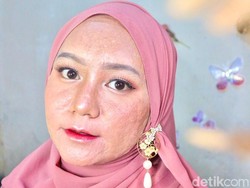 Kisah Beauty Influencer Berjerawat, 9 Tahun Jadi Acne Fighter