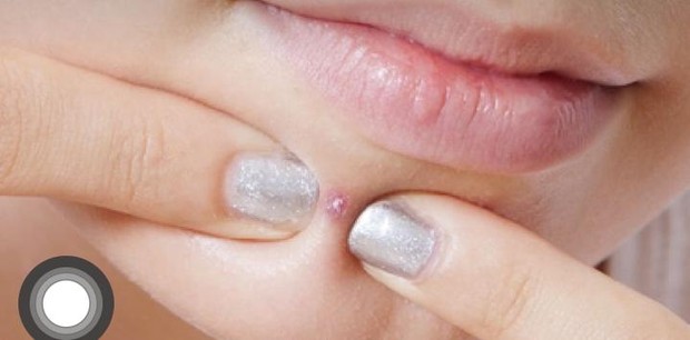 ilustrasi jerawat yang muncul di dagu/pinterest.com/SHEfinds| Weddings ilustrasi jerawat yang muncul di dagu/pinterest.com/SHEfinds| Weddings