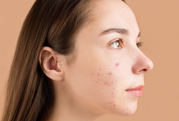 Ilustrasi jerawat/Pexels.com/Anna Nekrashevich Ilustrasi jerawat/Pexels.com/Anna Nekrashevich