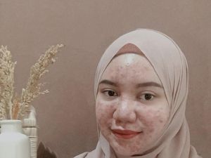 Efek Krim Abal-abal, Wanita Ini Berjuang Lawan Jerawat Sampai Makan Cicak