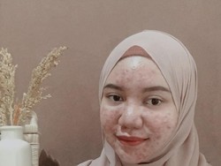 Efek Krim Abal-abal, Wanita Ini Berjuang Lawan Jerawat Sampai Makan Cicak
