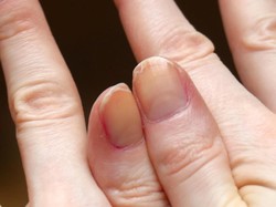 Mengapa Kuku Bisa Berwarna Kuning? Ini Penyebabnya