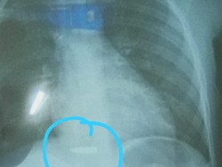 Peluru Nyasar Bersarang di Tubuh Bocah Cihampelas Berhasil Dikeluarkan