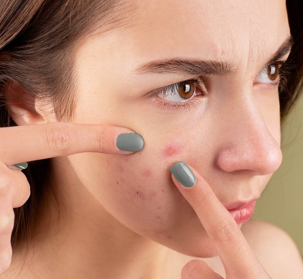 Hindari memencet jerawat/Foto: Pexels.com/Anna Nekrashevich jerawat