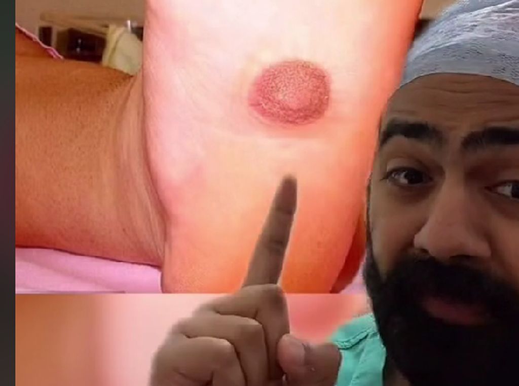 Kasus Unik Puting Payudara Tumbuh di Telapak Kaki, Ini Penjelasan Dokter Kasus Unik Puting Payudara Tumbuh di Telapak Kaki, Ini Penjelasan Dokter
