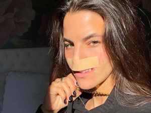 Model yang Bibirnya Lepas karena Diserang Anjing Kini Punya Bibir Baru