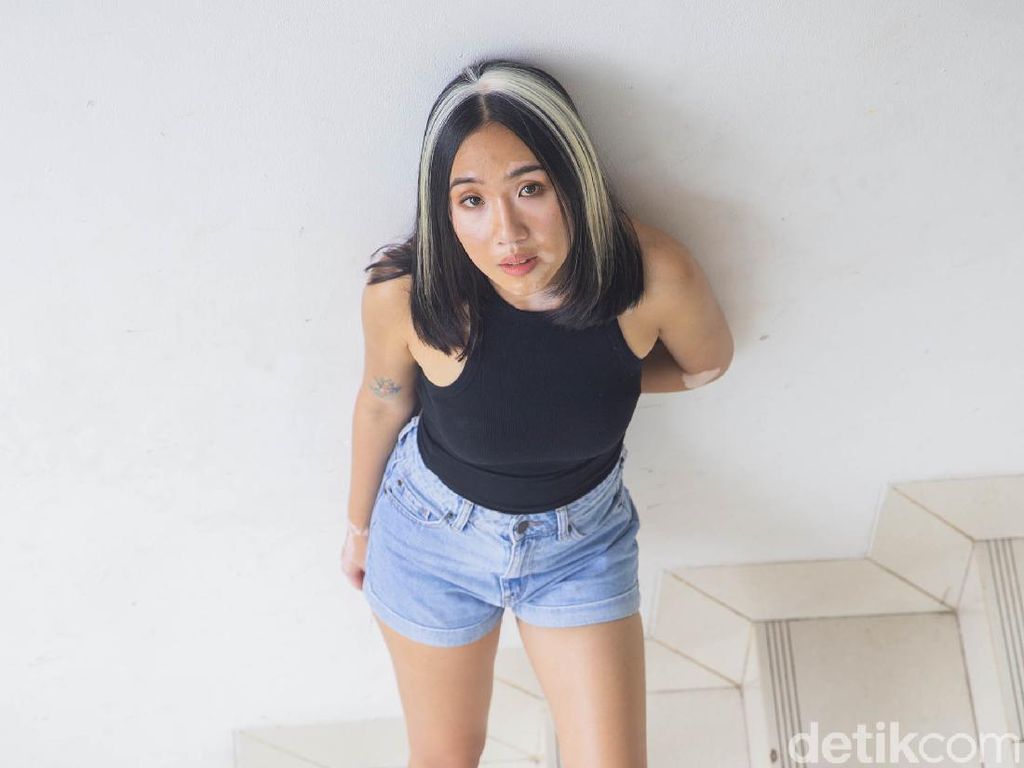 9 Pesona Zsazsa Caesar, Model Inspiratif yang Ubah Stigma Vitiligo 9 Pesona Zsazsa Caesar, Model Inspiratif yang Ubah Stigma Vitiligo