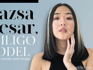 Zsazsa Caesar, Model Asal Bandung dengan Kondisi Kulit Vitiligo