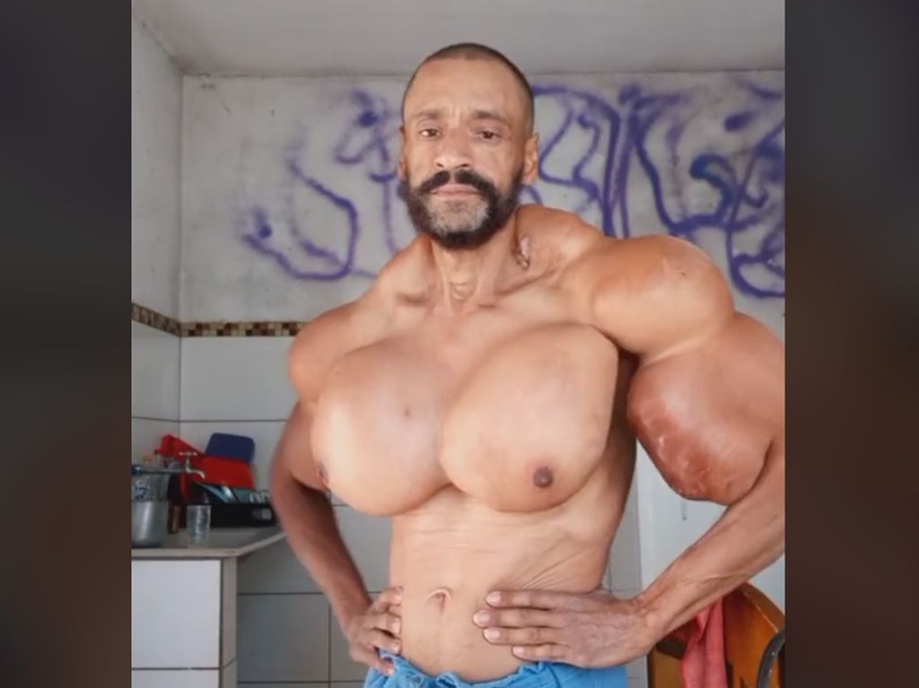 Viral Binaragawan Tewas Gegara Nekat Suntik Otot Pakai Minyak Biar Mirip Hulk Viral Binaragawan Tewas Gegara Nekat Suntik Otot Pakai Minyak Biar Mirip Hulk