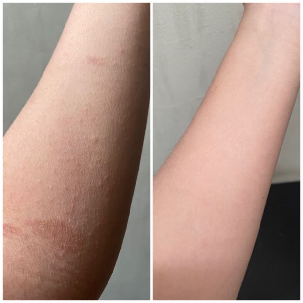 Dokumentasi foto sebelum dan sesudah penggunaan Rooibos BeauTea.