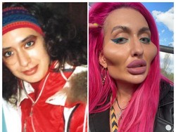 Tak Dikenali, Begini Foto Before-After Model dengan Pipi Terbesar di Dunia