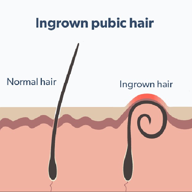 Rambut yang tumbuh ke dalam/twitter.com/thehealththing Ingrown hair, waxing