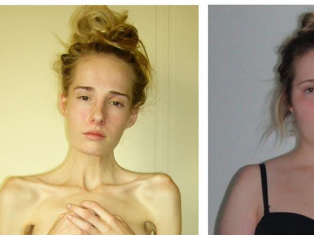 Wanita Ini Hampir Meninggal karena Anoreksia & Bulimia, Beratnya Cuma 28 Kg Wanita Ini Hampir Meninggal karena Anoreksia & Bulimia, Beratnya Cuma 28 Kg