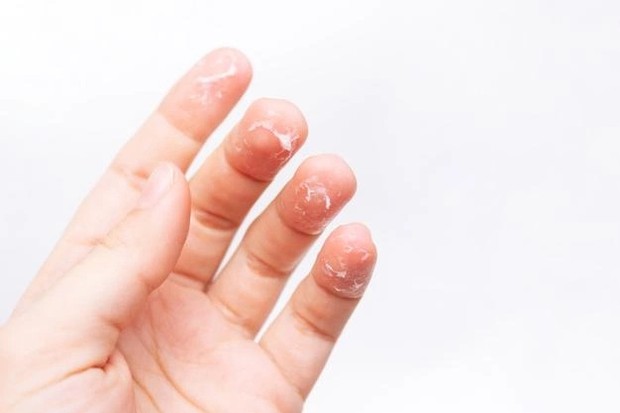 Ilustrasi masalah kulit/ Foto: Freepik.com