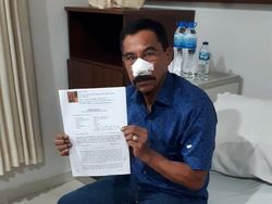 Eks Bupati Boltim yang Digigit Hidungnya Diizinkan Pulang Usai Dioperasi
