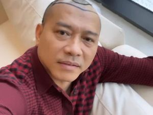 Transplantasi Rambut Seperti Anang Hermansyah, Efektifkah Atasi Kebotakan? Transplantasi Rambut Seperti Anang Hermansyah, Efektifkah Atasi Kebotakan?
