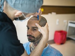 Apakah Transplantasi Rambut Efektif Atasi Kebotakan? Ini Penjelasannya