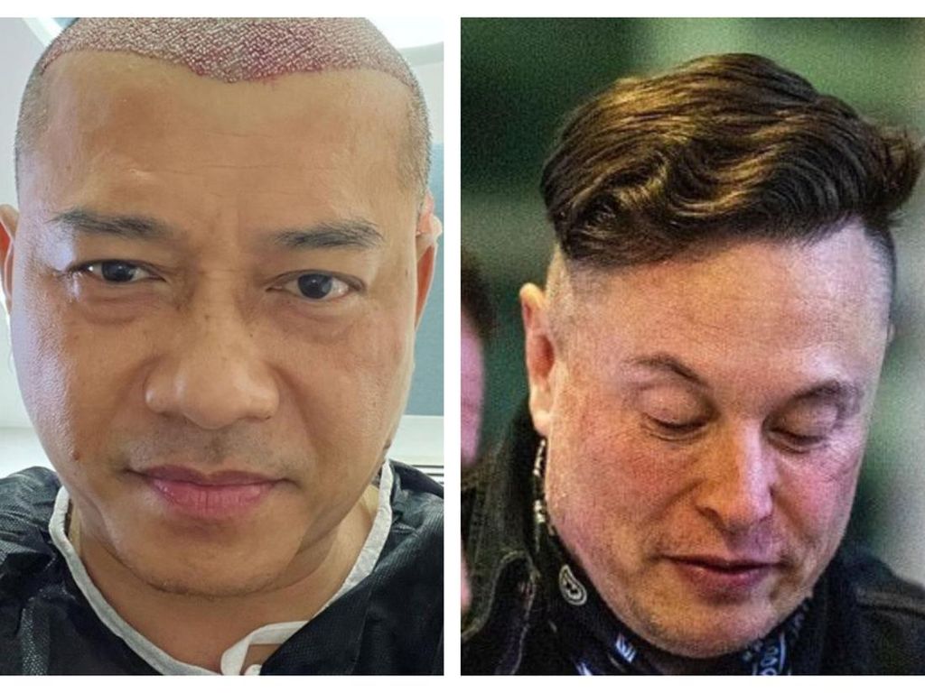 Anang Hermansyah Botak Transplantasi Rambut, Elon Musk Juga Pernah